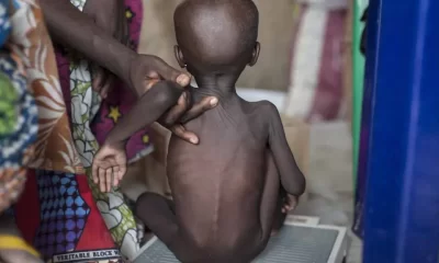 Hardship: Nigerian Govt Confirms Over 4m Children Malnourished In Northeast, Northwest
